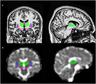 Increased Sodium Concentration in Substantia Nigra in Early Parkinson's Disease: A Preliminary Study With Ultra-High Field (7T) MRI